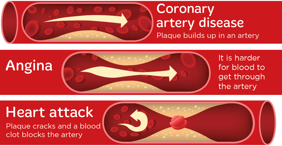 coronary artery disease angina heart attack comparison graphic