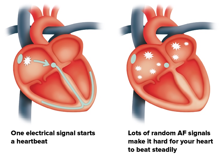 Heart Murmur And Irregular Heartbeat Doctorvisit