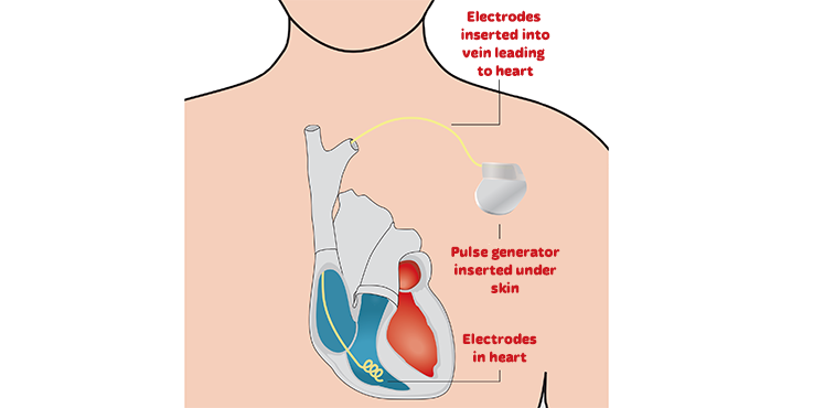 Electrodes are inserted into a vein leading to the heart. The pulse generator is inserted under the skin.