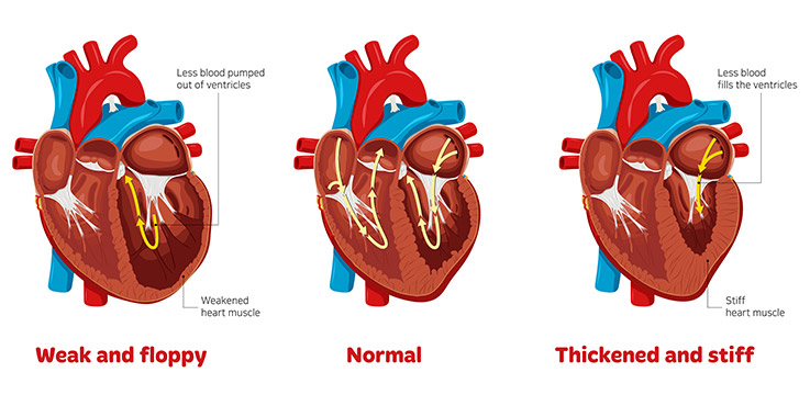 Anatomical drawing of the heart in three states: a normal state, a weak and floppy state and a stiff and thickened state.