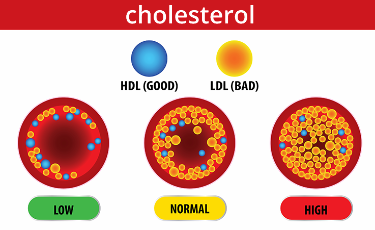 Cholesterol. Blue dots represent good cholesterol (HDL) and yellow dots represent bad (LDL). Lots of yellow dots in an artery is bad. A mix of yellow and blue is normal.