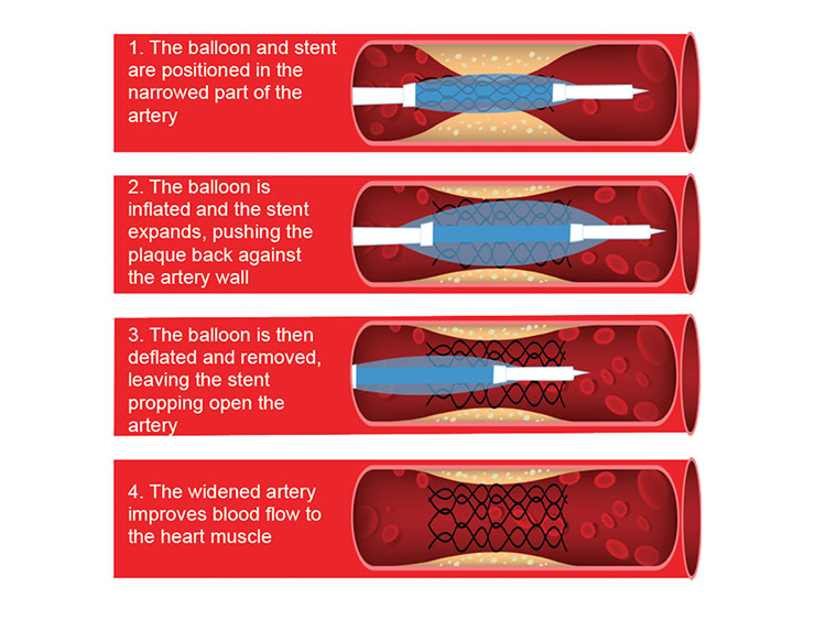 What does a stent do? 1. the balloon & stent are positioned in the narrowed part of the artery. 2. the balloon is inflated & the stent expands, pushing the plaque back against the artery wall. 3.The balloon is deflated & removed, leaving the stent propping open the artery. 4. The widened artery improves blood flow to the muscle