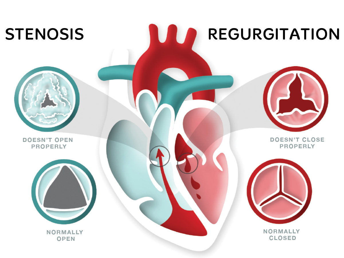 Difference between stenosis and regurgitation heart diagram
