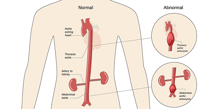 A normal body showing a normal aorta compared to an abnormal body showing thoracic aortic aneurysm bulge and abdominal aortic aneurysm bulge